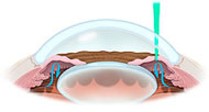 Glaucoma Surgery Port Huron